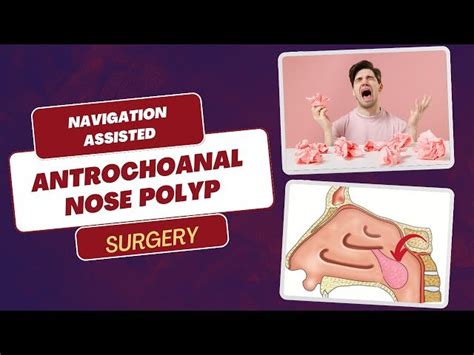 A Deep Dive into Nose Polyp 4K Surgery - Antrochoanal Polyp Surgery - SinusDoctor