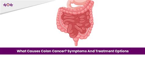 What Causes Colon Cancer Symptoms And Treatment Options