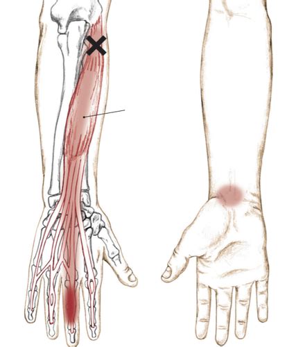 Extensor Carpi Radialis Longus The Trigger Point Referred Pain Guide Atelier Yuwa Ciao Jp