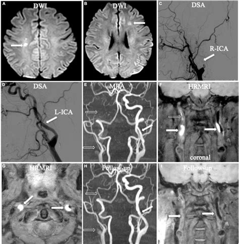 Vertebral Artery Dissection Mri