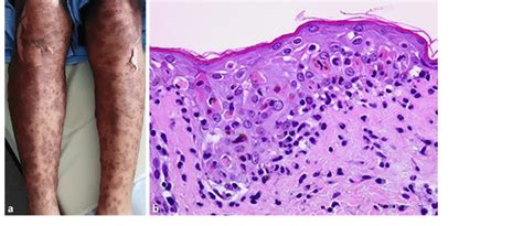 A Picture And Histopathology Of Toxic Epidermal Necrolysis A Diffuse