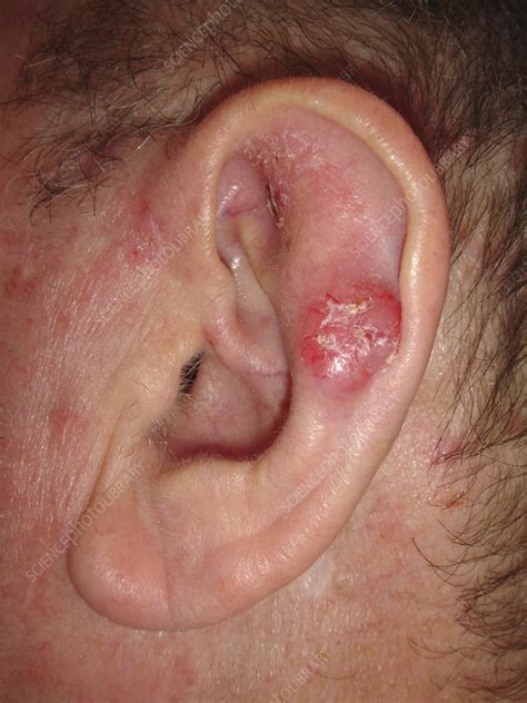 Melanoma Ear