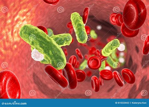 Sepsis And Life Pictured As A Word Sepsis And A Wreck Ball To