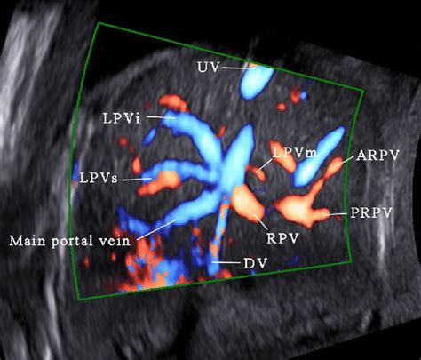 Fetal Umbilicalportalsystemic Venous Shunt 54 OFF