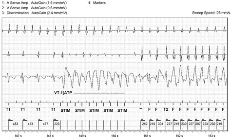 Electrophysiology - ECG Made Simple