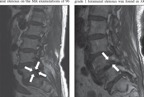 [PDF] A practical MRI grading system for lumbar foraminal stenosis ...