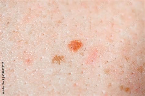 Mole Birthmark Nevus Macro Photo On Human Skin Crochordon Or Soft