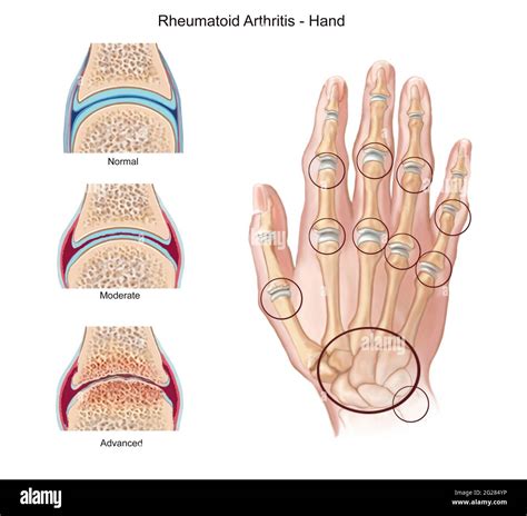 Stages Of Rheumatoid Arthritis On Hand With Highlight Of Joints