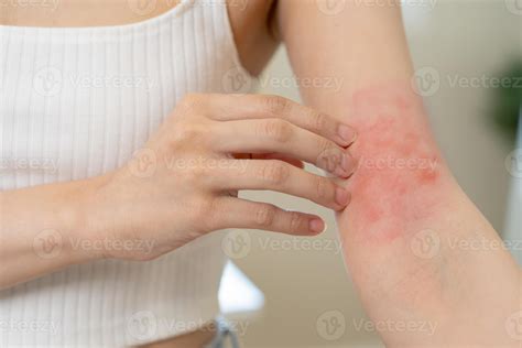 Dermatology Asian Young Woman Girl Hand In Her Arm Allergy Allergic