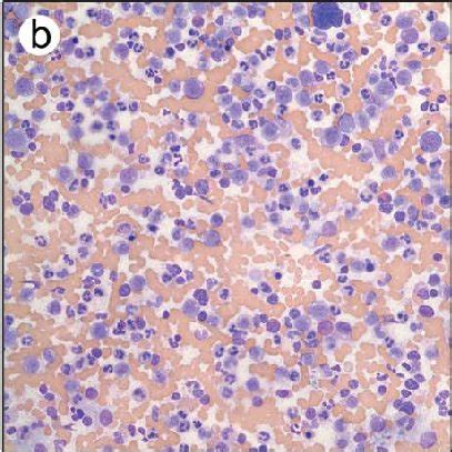 Pdf Chronic Neutrophilic Leukemia