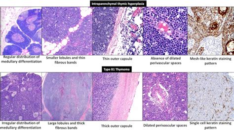 Thymic Parenchymal Hyperplasia Modern Pathology