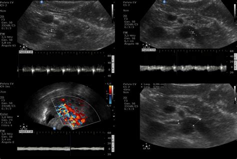 Nutcracker Syndrome Ultrasound