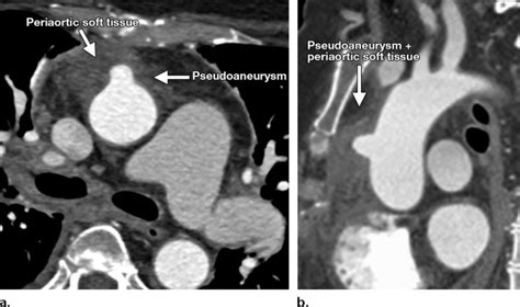 Axial A And Sagittal B Contrast Enhanced Ct Images Of A Patient Who