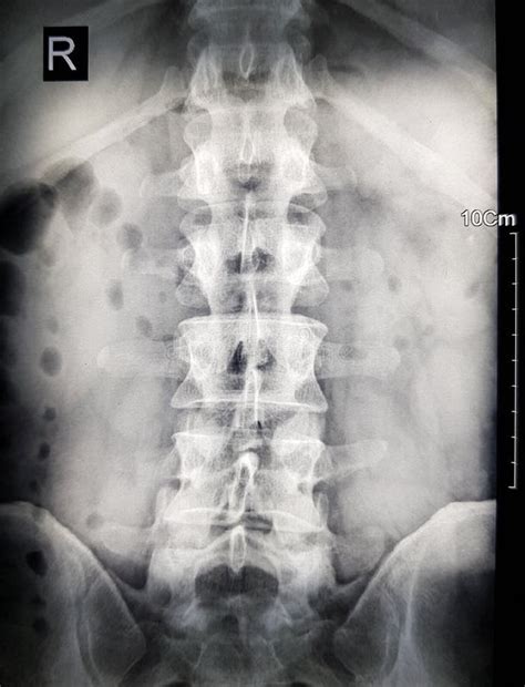 X-ray of a human spine stock photo. Image of lung, treatment - 242483754