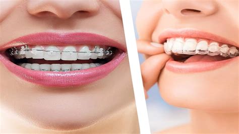 Invisalign Vs Traditional Braces Pros And Cons 1 Health Workout