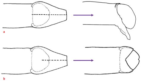 Half Cut Circumcision