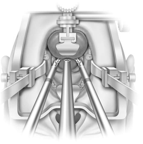 Transoral Robotic Surgery Operative Techniques In Otolaryngology Head And Neck Surgery