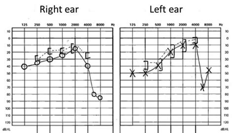 Hearing Test Of Patient Number 1 Download Scientific Diagram