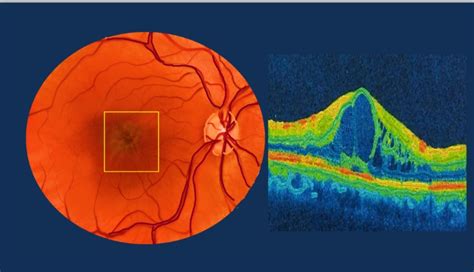 Intermediate Uveitis Understanding Symptoms Signs And Complications