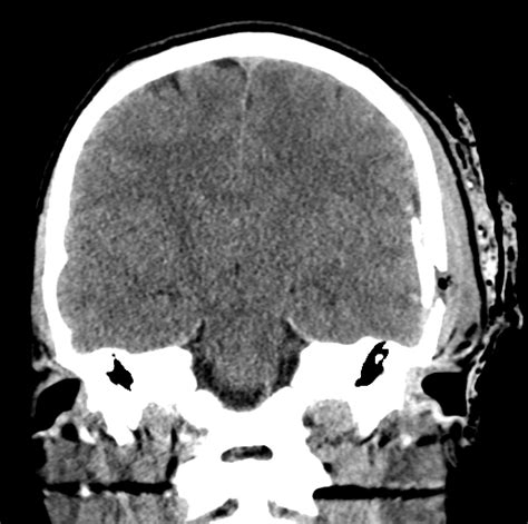 Depressed Skull Fracture With Extradural Hematoma Image