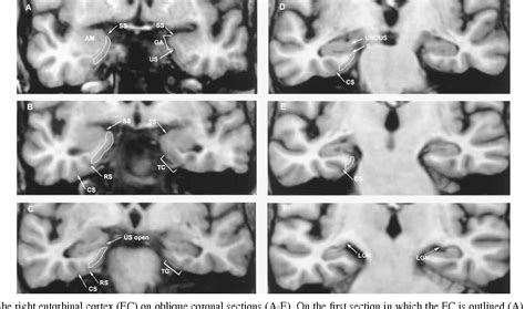 Figure 2 from MRI of human entorhinal cortex: a reliable protocol for ...