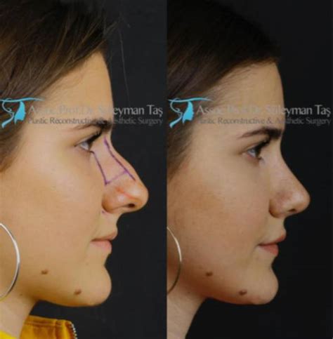 Scarless Nose Operation By Dr Tas By Doctor Suleyman Tas Md Istanbul