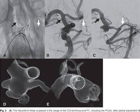 Figure 2 From Treatment Of Recurrent Aneurysm Of The Internal Carotid