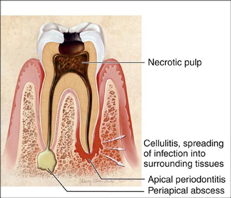 Dental Pain Periapical Abscess Tooth Abscess Anesthesia Key