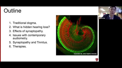 Hidden Hearing Loss The Effects Of Synaptopathy Youtube