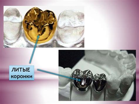 Искусственные коронки. Временные коронки - презентация онлайн