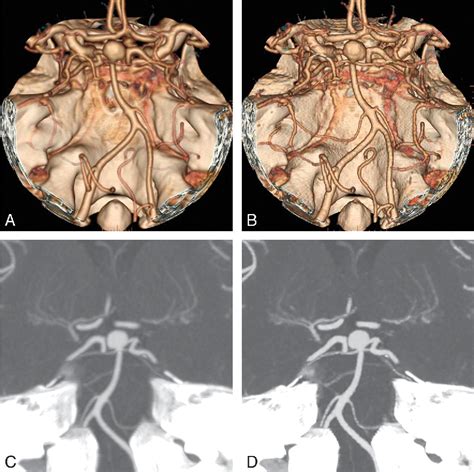 Figure From Improved Delineation Of Arteries In The Posterior Fossa