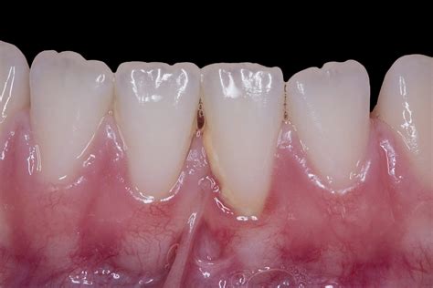 Gum Grafting Orange Periodontics And Dental Implantology