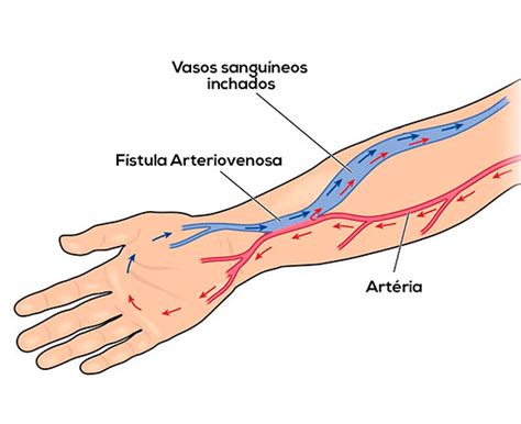 Enfermedades Vasculares F Stulas Arteriovenosas