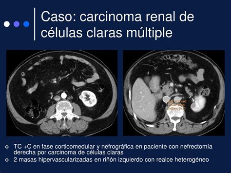 Ppt El Tcmd En El Diagn Stico De Los Tumores Renales M Ltiples