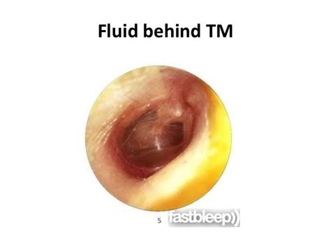 Tympanic Membrane