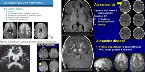 Pediatric White Matter Disease