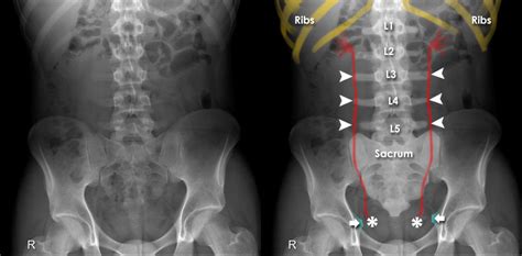 Abdominal X Ray System And Anatomy Bones