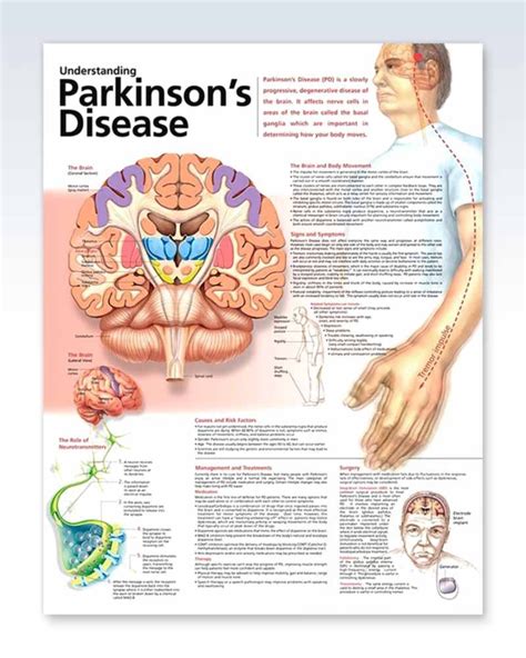 Understanding Parkinson S Disease Chart 20×26 Artofit