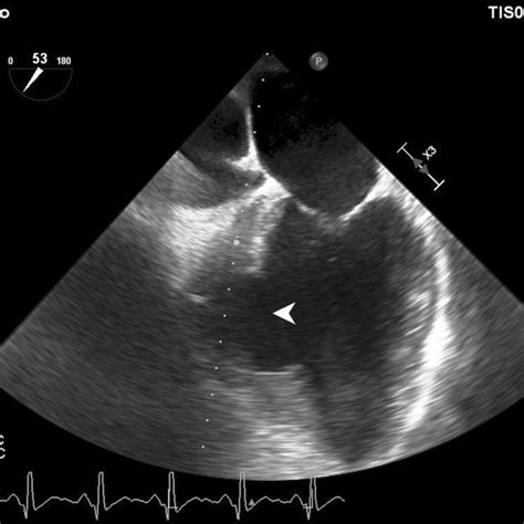 Intraoperative Post‐repair Transesophageal Echocardiography