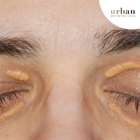 Xanthelasma Types, Causes, Symptoms & Treatment | USHC