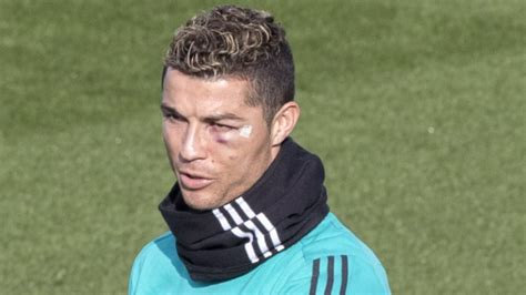 Cristiano Ronaldo po kontuzji Wygląda jak po nokaucie ZDJĘCIA