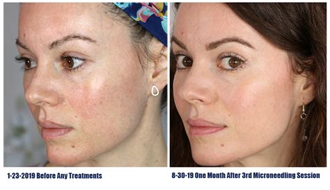 Home Micro Needling Before And After