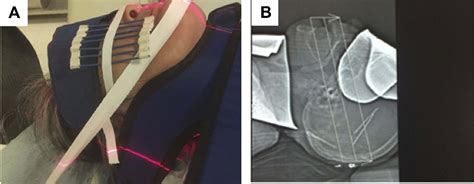 Figure From Bipolar Radiofrequency Ablation Of Mandibular Branch For