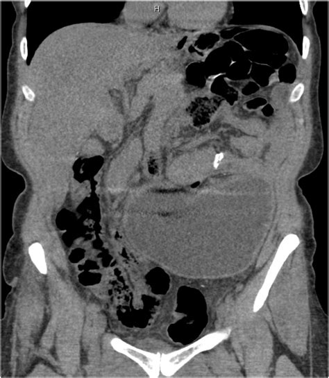 Axial View Of The Abdominal Ct Scan Showing Volvulized And Dilated