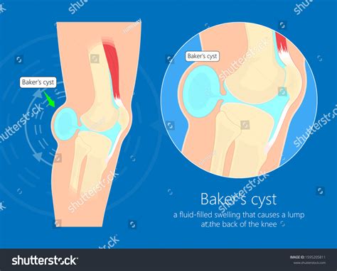 Bakers Cyst Popliteal Swelling Knee Joint Vector De Stock Libre De