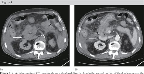 Figure 1 From Duodenal Diverticular Bleeding Successfully Treated Using