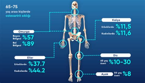 Osteoartrit Kireçlenme Nedir Nedenleri ve Tedavisi Kayhan Turan