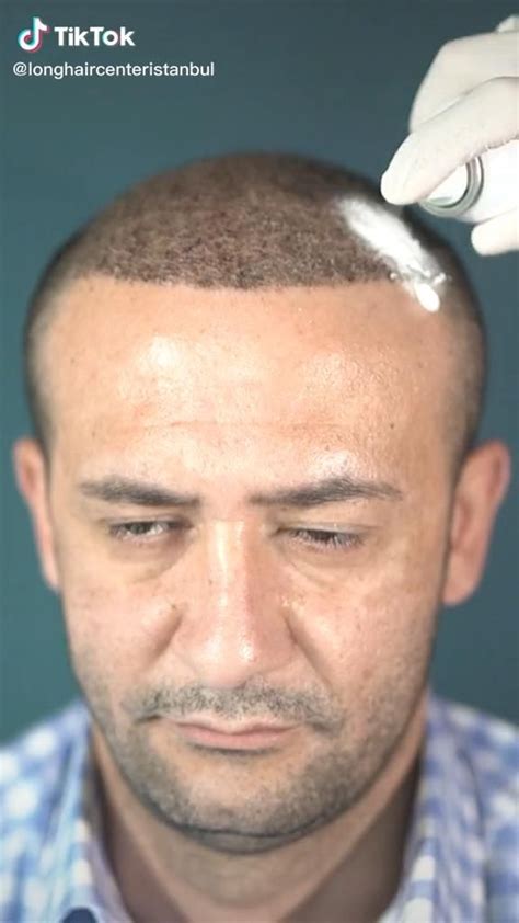 How To Remove All Scabs 10 Days After A Hair Transplant