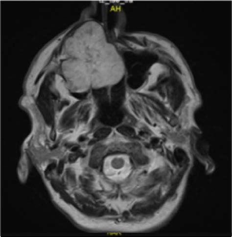 Brain Mri Showed Right Maxillary Sinus Mass Extending To The Nasal Download Scientific Diagram