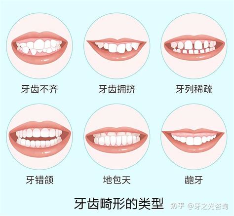 什么样的人要做牙齿矫正？我该不该做矫正？ 知乎